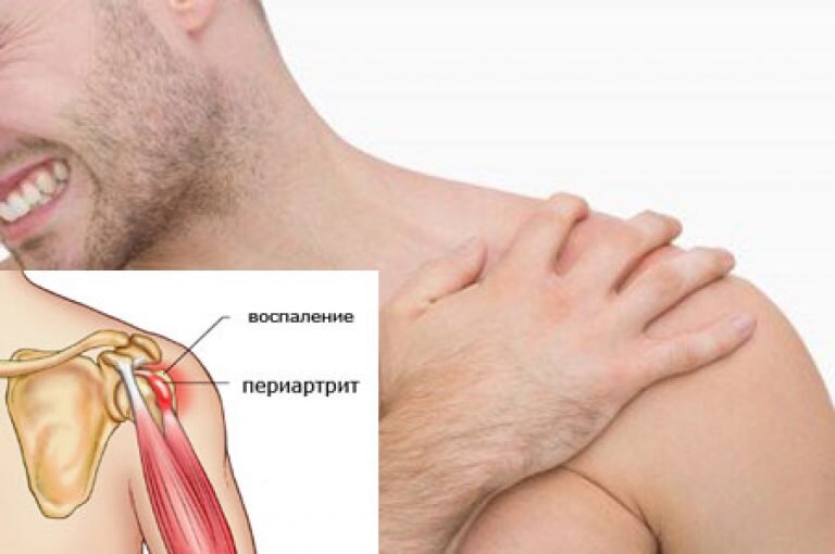 7 главных причин боли в плече
