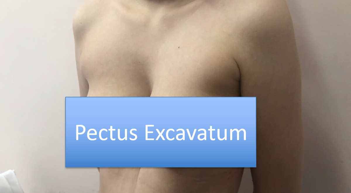 Воронкообразная деформация грудной клетки у женщин. Фото нашей пациентки.