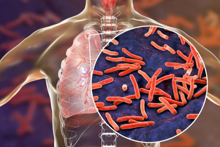 Туберкулёз. Всё, что нужно знать об этом заболевании