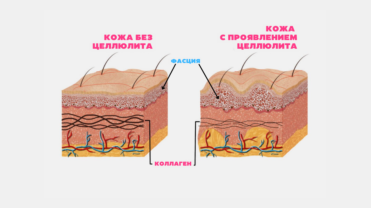 Косметолог-массажист: коррекция целлюлита в домашних условиях