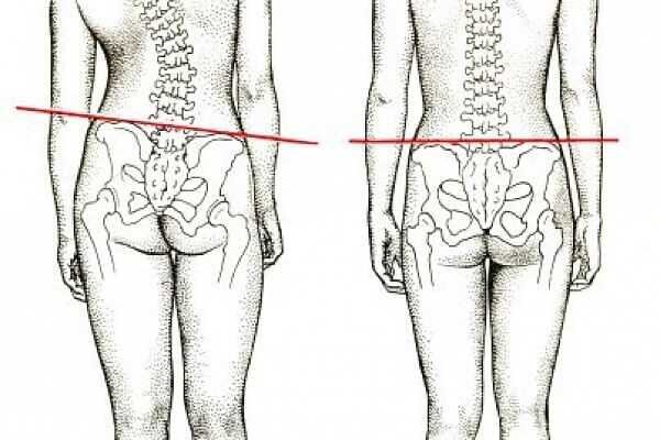 Разная длина ног: что с этим можно сделать? | Блог ФормТотикс