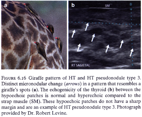 Фрагмент-цитата из руководства по УЗИ щитовидной железы Duick DS, Lupo MA, Levine RA Thyroid and Parathyroid Ultrasound and Ultrasound-Guided FNA. Link. 2018. 546 p. 