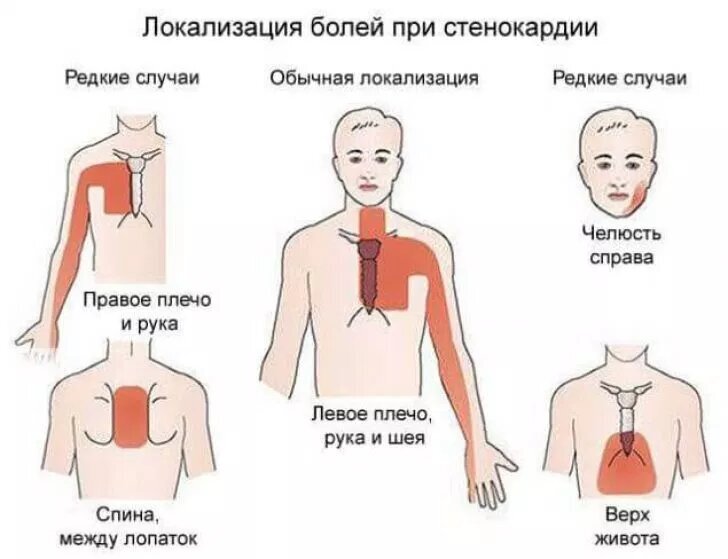 При вдохе отдает в сердце. Локализация боли при стенокардии. Локализация боли в сердце