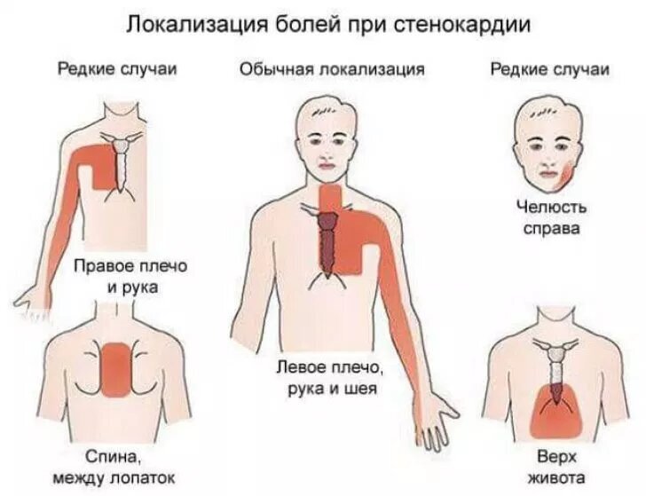 Боль в груди — причины, обследование и лечение | Симптомы | Клиника «Консилиум»