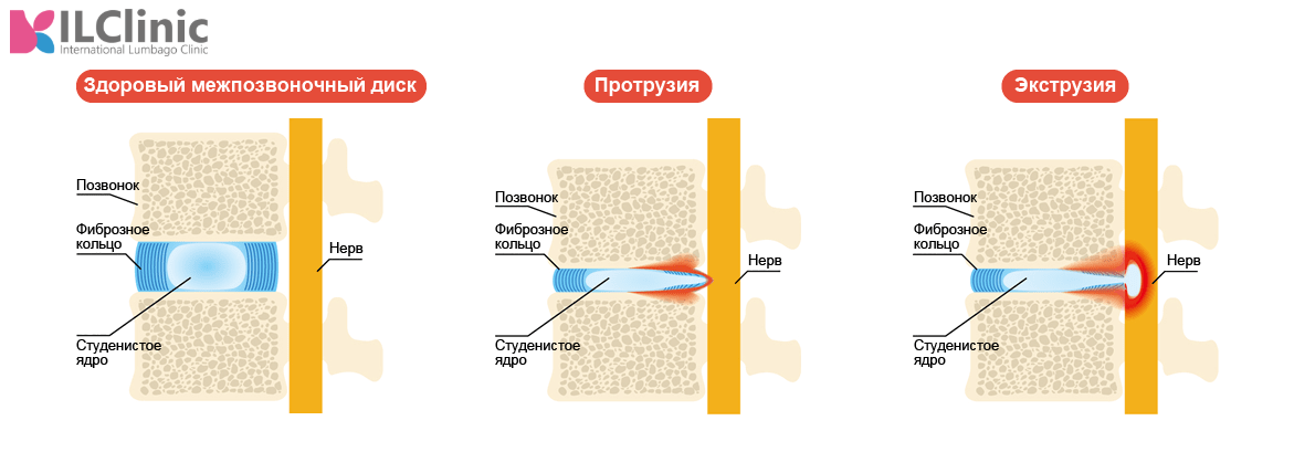 Межпозвоночная грыжа