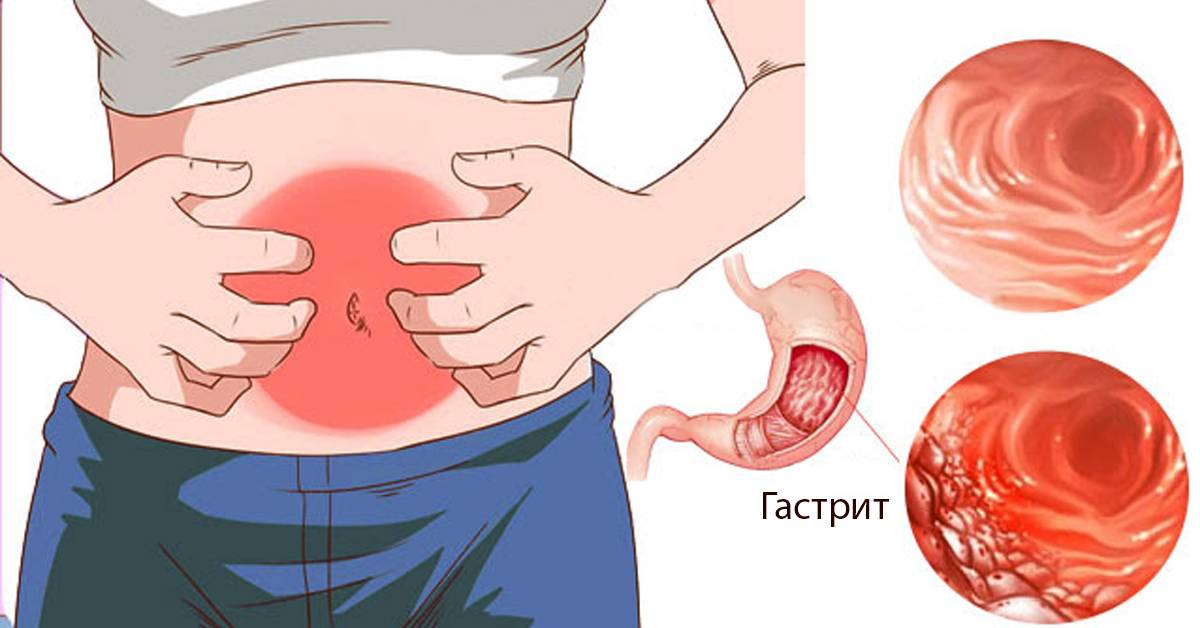 Гастралгия что это такое