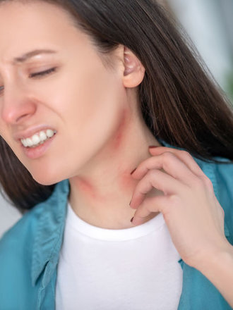 крапивница