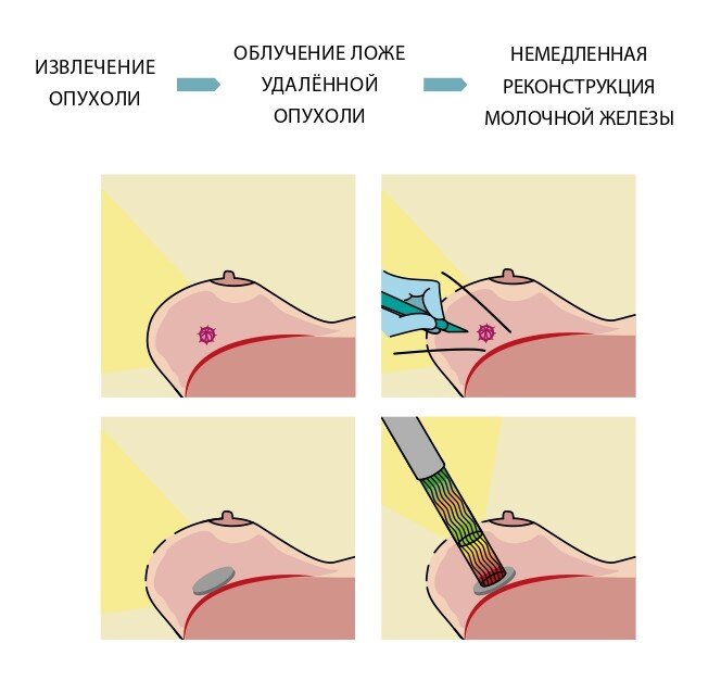 Удаление груди: показания, подготовка к операции, осложнения