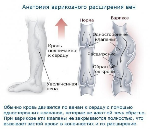 Варикозное расширение вен нижних конечностей