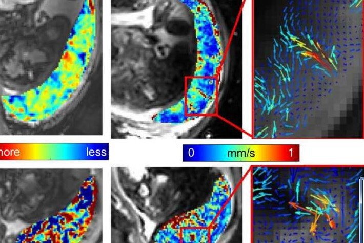 Рис .1 МРТ сканирование показывает информацию о кислороде крови и скорости движения крови в плаценте как для здоровой беременности (сверху), так и для преэклампсии (снизу). Фото: Dr Neele Dellschaft