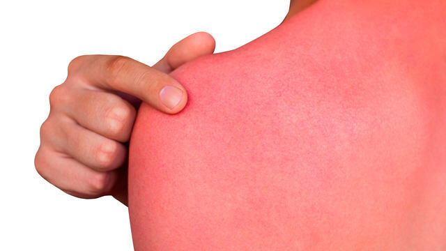 фото взято для ознакомления из источника https://medportal.ru/enc/dermatology/dermotrauma/sunburn/