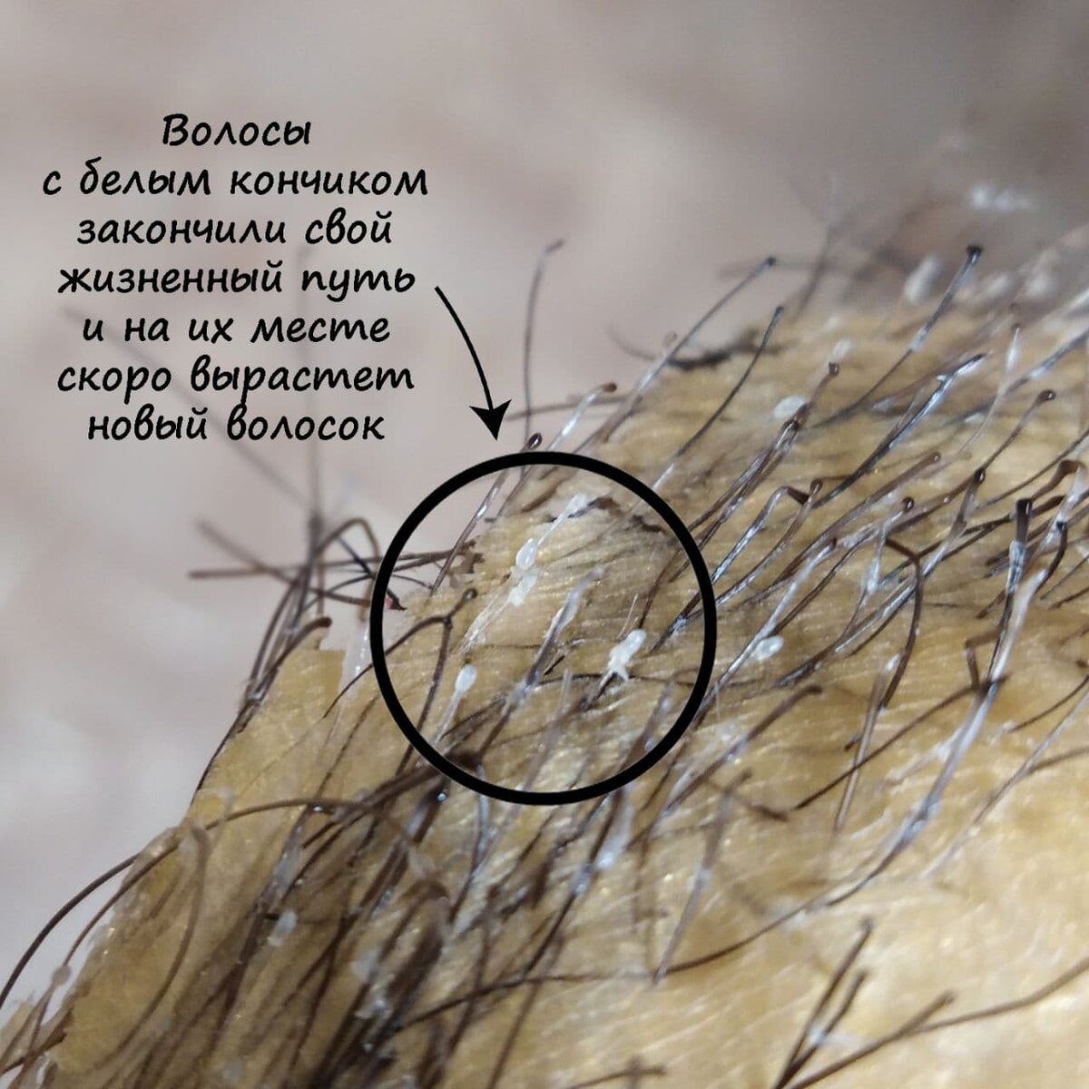 Волос с белым корешком закончил свой жизненный путь. Через несколько дней, недель выпадет сам или его вытолкнет новый растущий волос