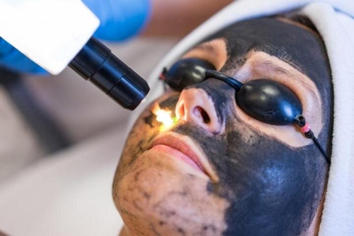 Лазерный карбоновый пилинг