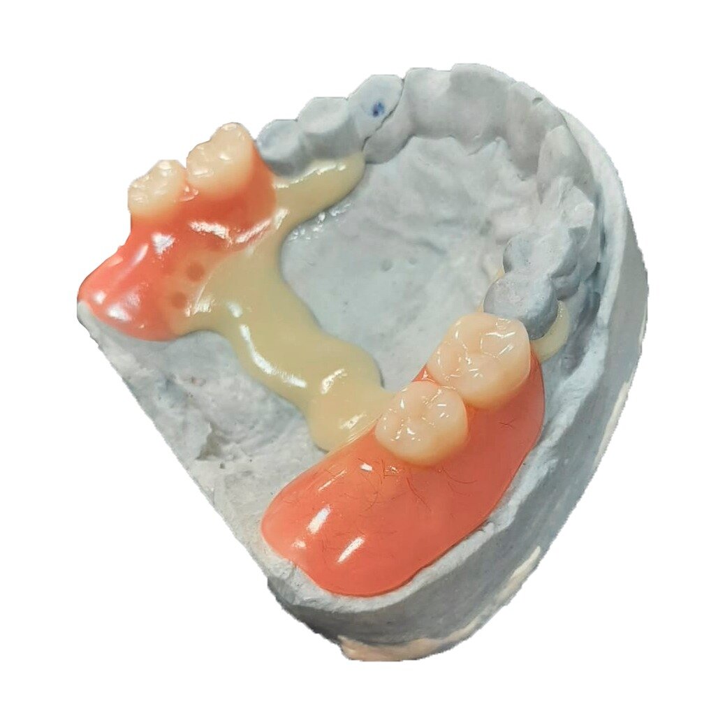 Протез Квадротти, изготовленный в нашей лаборатории.