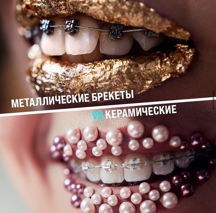 Неважно, что вы выберете: металл или керамику. Суть и скорость лечения не изменяться.