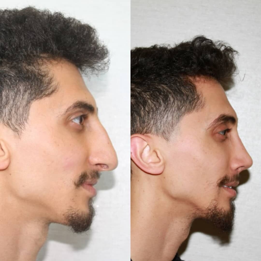 Сон нос мужчины. Мужская ринопластика до и после. Ринопластика носа мужчины до и после. Мужская ринопласти да и после.