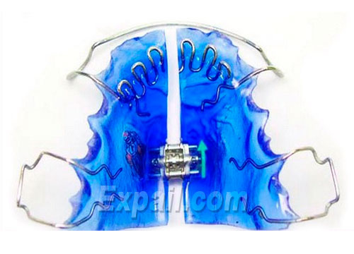 Ортодонтические пластинки.