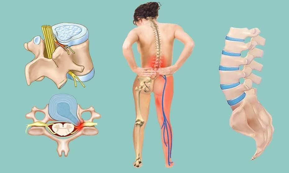 Воспаление седалищного нерва.