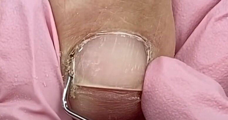 Подногтевая мозоль в пазухе ногтя. Неправильная обработка пазухи, ноготь оторван от ложа в боковой складке. Последствие перепила.