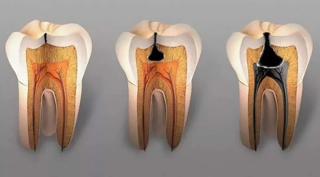Что делать, если выпала временная пломба – статьи стоматологической клиники «Доктор Мартин»