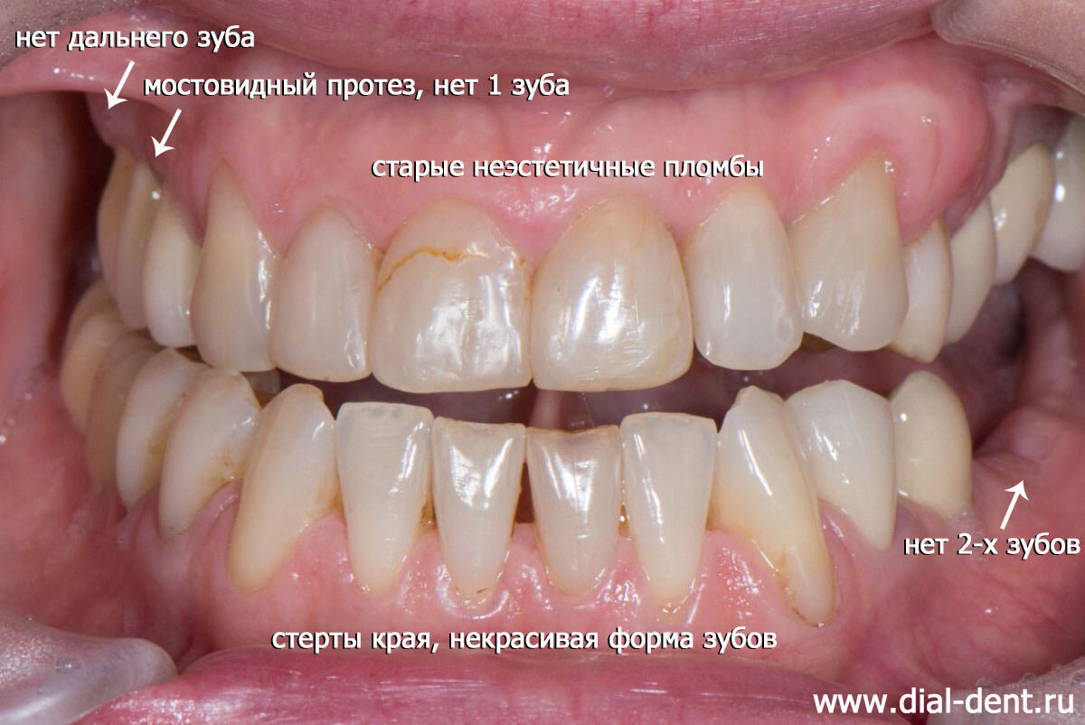 Преображение улыбки – имплантация и полное протезирование зубов |  Стоматология Диал-Дент | Дзен