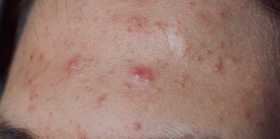 Акне в области лба