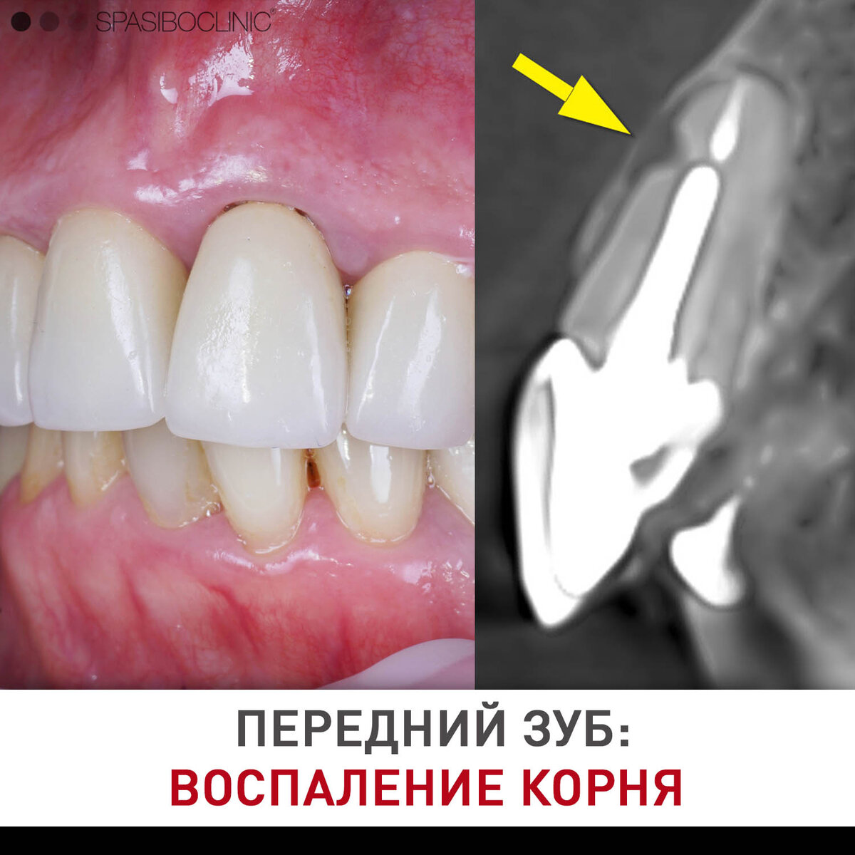 Болит зуб под коронкой: что делать?