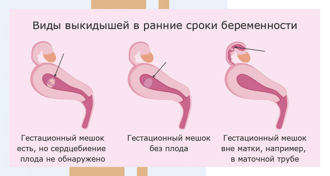 Через сколько можно повторно беременеть. Через сколько можно повторно беременеть