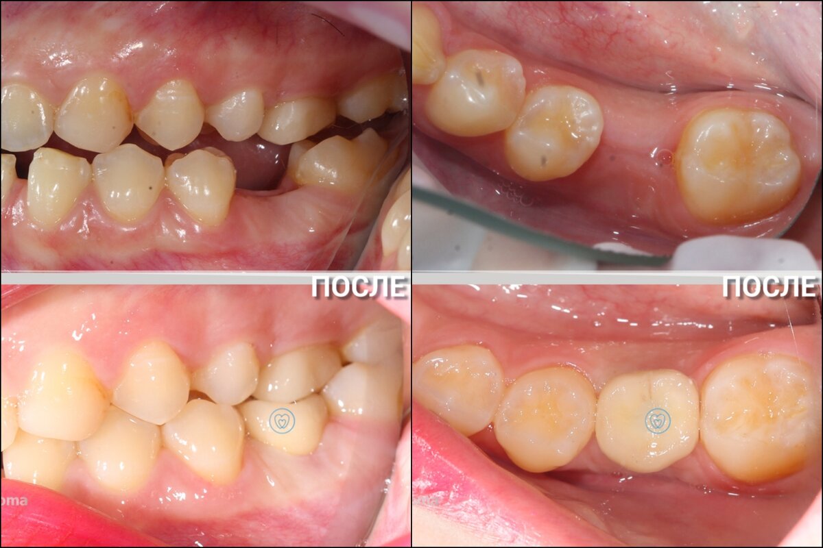 Улыбка на миллион – это не миф: Как я лечила зубы и почему так и не  вылечила | ROXYS CHOICE | Дзен