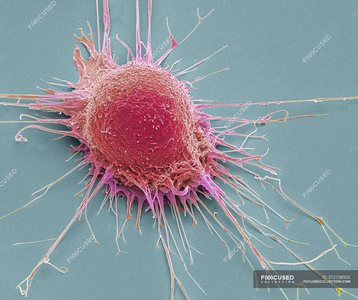 Раковая клетка простаты на клеточном уровне