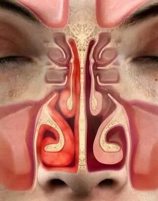 Отечность слизистой, заложен нос – лечение у отоларинголога