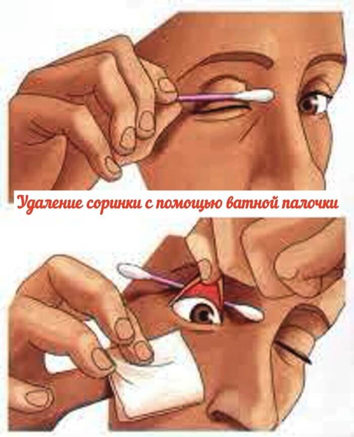 [caption id="attachment_5824" align="aligncenter" width="700"] Удаление соринки с помощью ватной палочки[/caption]