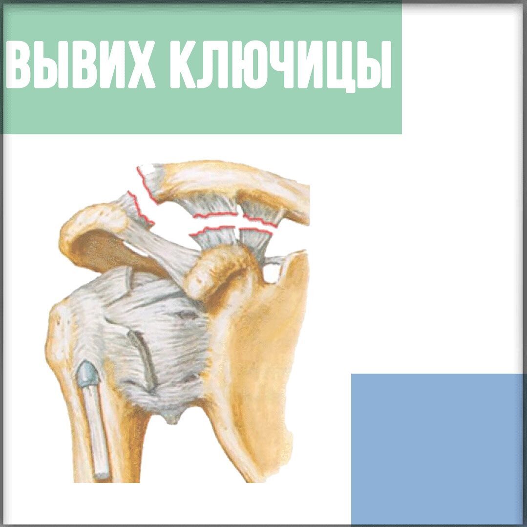 Вывих ключицы | Андрей Светашов | Дзен