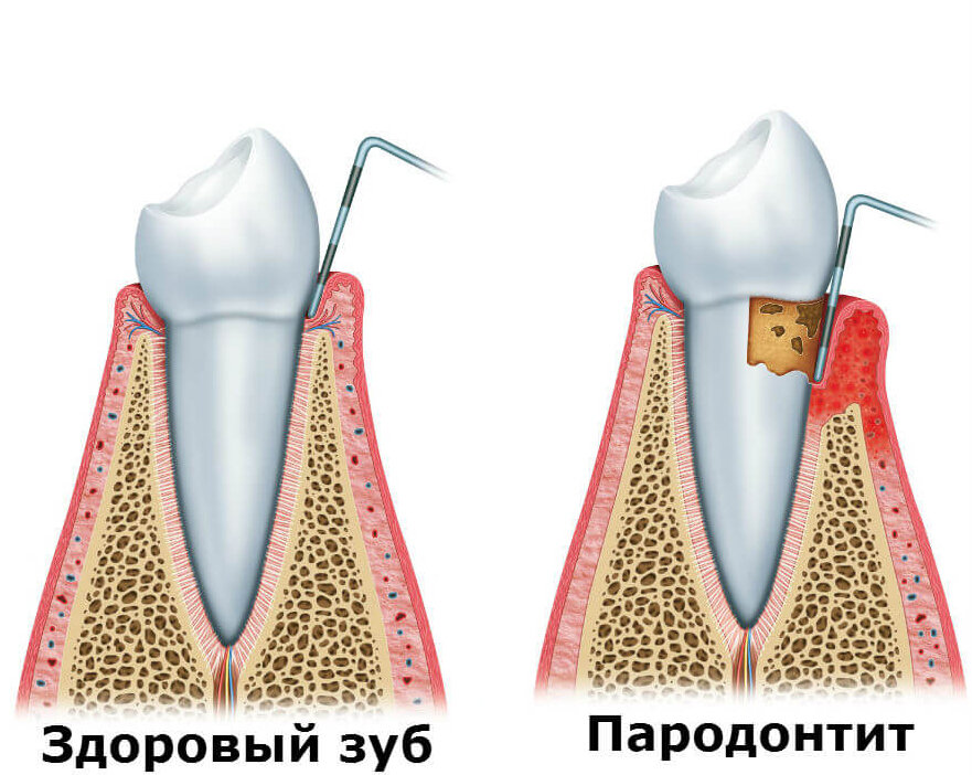 Пародонт (от греч. "одонтос" - зуб и "пара" - вокруг, около) – это комплекс тканей, окружающих и удерживающих зуб – десна; связки (периодонт); цемент, покрывающий  корень и костная ткань, окружающая корень зуба. Но устойчивое положение зуба может неожиданно пошатнуться.  Безобидное, на первый взгляд, поверхностное воспаление  и кровоточивость  десен  - не что иное,  как гингивит – воспаление десны (от лат. gingiva – десна).  По сути, это начальная стадия пародонтита, при котором воспаление десны распространяется на костную ткань пародонта. Симптомами пародонтита являются значительное количество зубных отложений; обнажение шейки, а затем и оголение корня зуба различной степени; отечность и кровоточивость десен; наличие пародонтального кармана; подвижность зубов. Особая опасность всех заболеваний пародонта кроется в том, что часто их начало и первые стадии  могут протекать без симптомов. Недаром стоматологи их называют «молчаливыми убийцами» зубов.