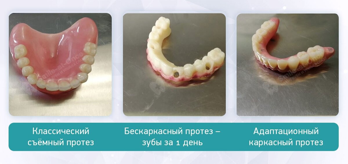 Виды временных протезов после all-on-4, all-on-6, базальной или скуловой имплантации. Выбор зависит от конкретной технологии восстановления зубов на имплантах. Фото: Smile-at-Once.ru.