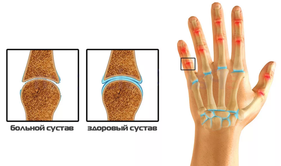 На рост на пальце руки. Ревматоидный артрит запястного сустава. Артрит межфалангового сустава пальца. Артроз межфаланговых суставов. Остеоартроз полиостеоартроз.