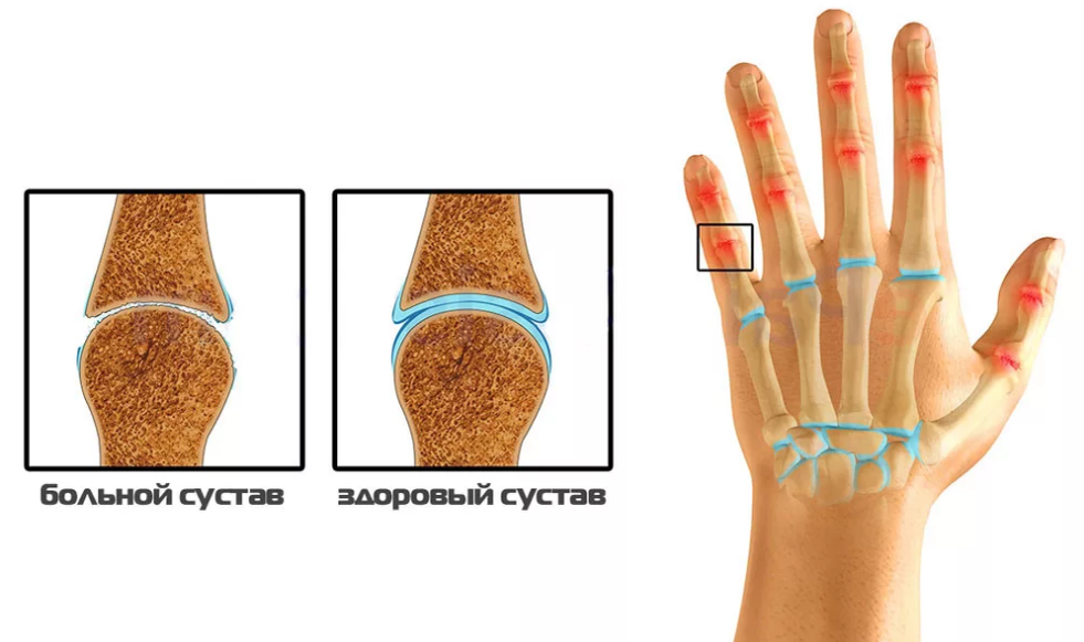 Боль в суставах. Лечение боли в суставах