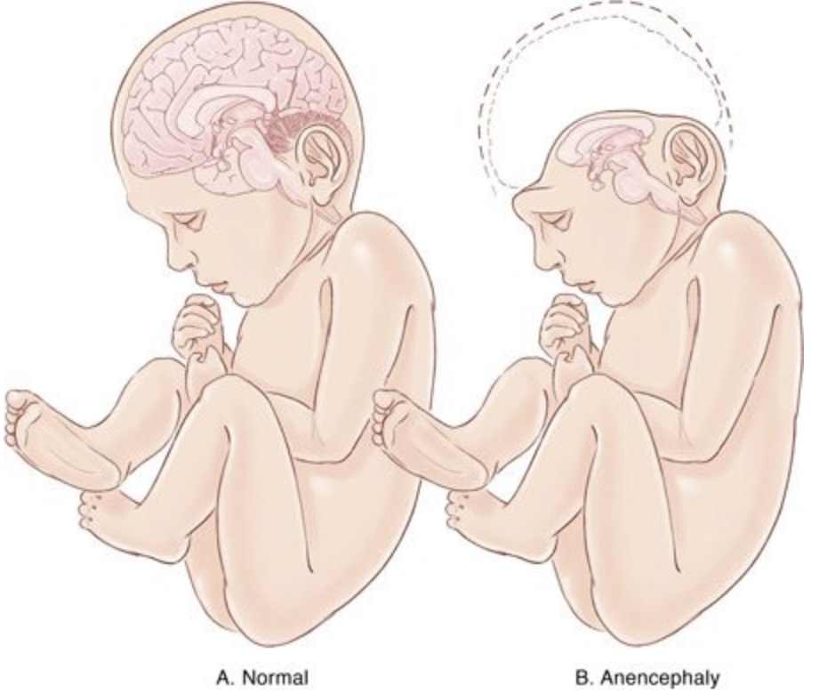 Рис. 1 - Сравнение новорожденого в норме и с анцефолией.