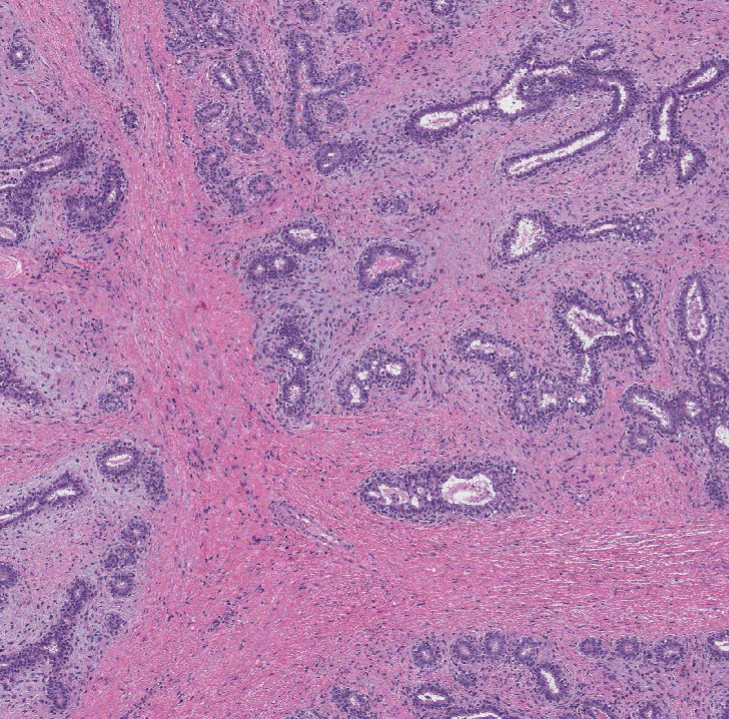 Классическая гистологическая картина фиброаденомы: железистые трубочки ("дырочки") и разросшаяся строма (сероватые участки вокруг трубочек).