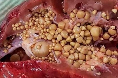 Камни в почках.