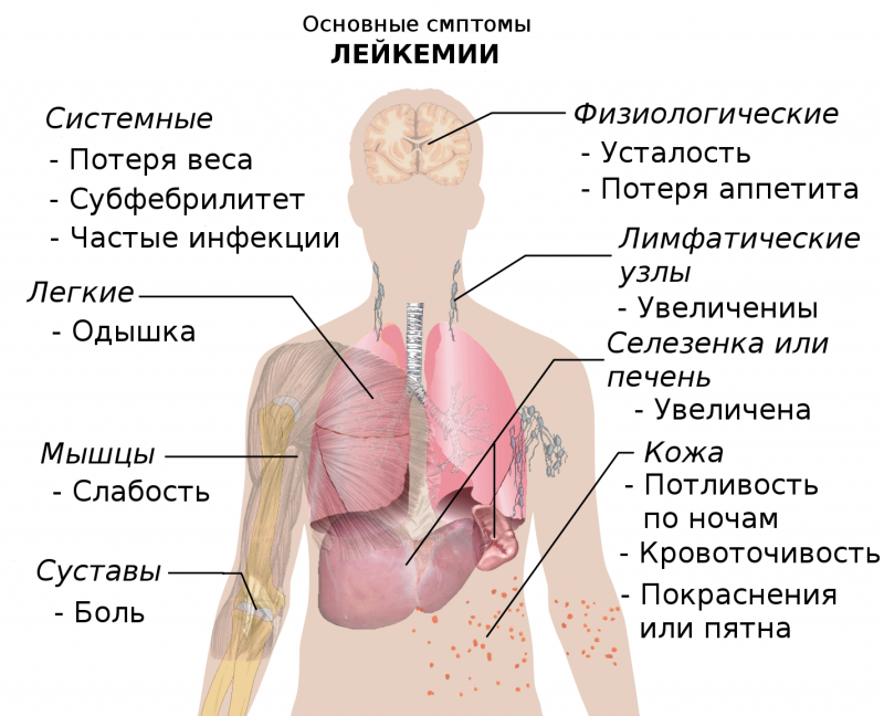 Болезнь селезенки симптомы. Спленомегалия при лейкозе. Особенности лейкозов у детей.