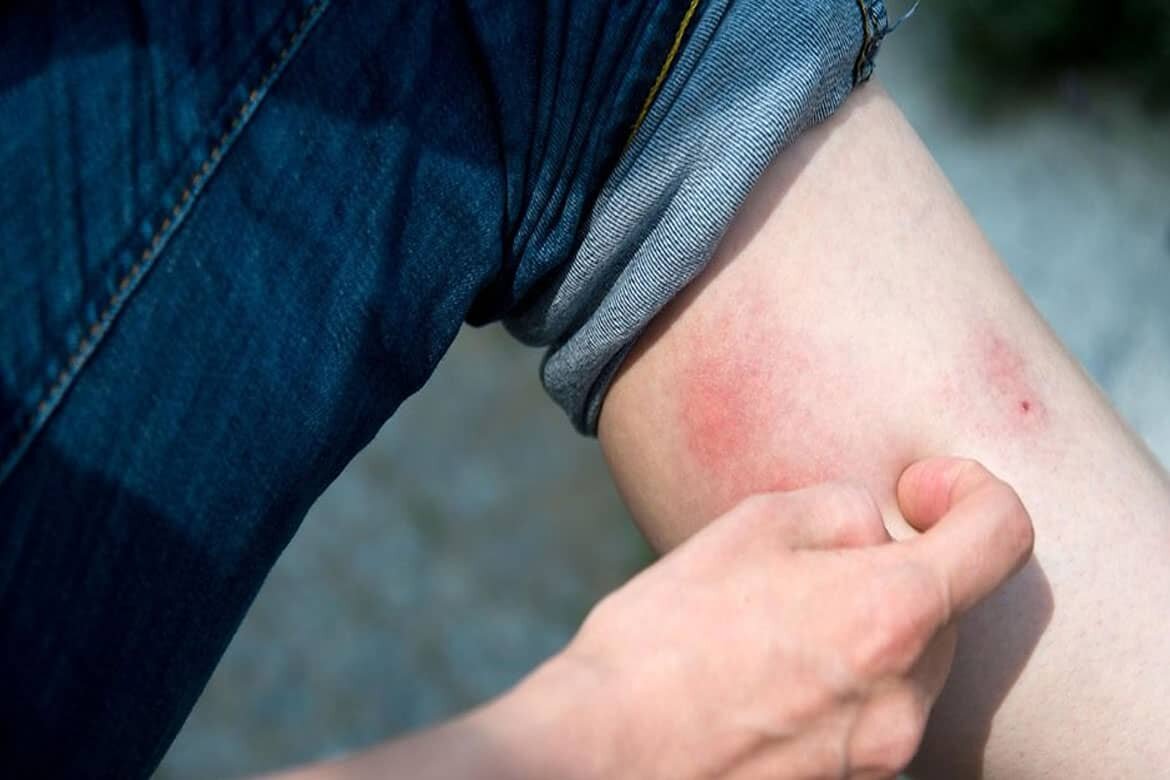 Так выглядит место укуса (использовано фото www.misterklop.ru)