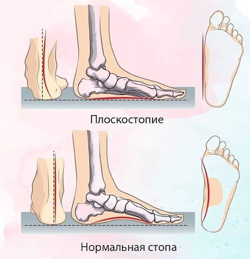 При ослаблении мышечно-связочных структур мышцы и связки стопы перестают справляться с высокой нагрузкой, в следствие чего стопа как бы оседает и уплощается (отсюда название - плоскостопие). Амортизирующая функция снижается.