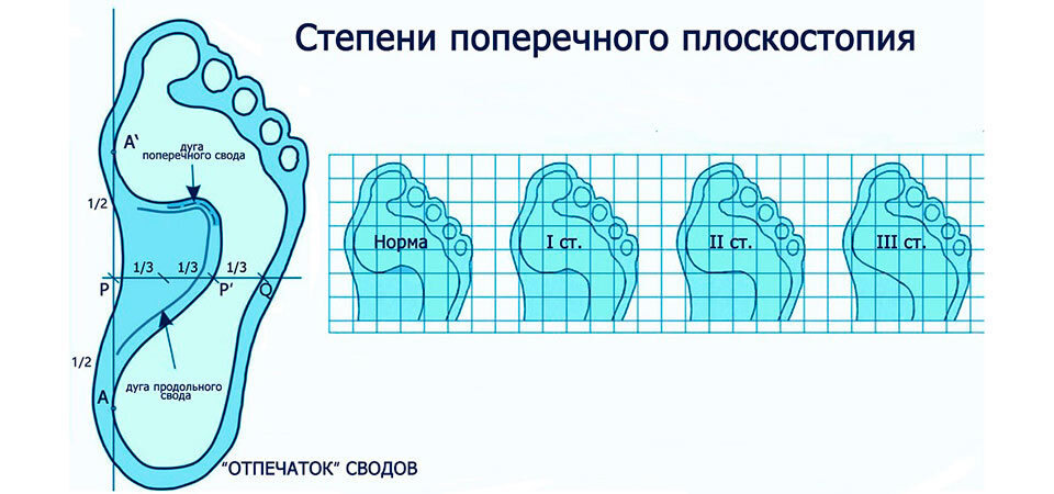 Почему при плоскостопии нельзя служить в армии?