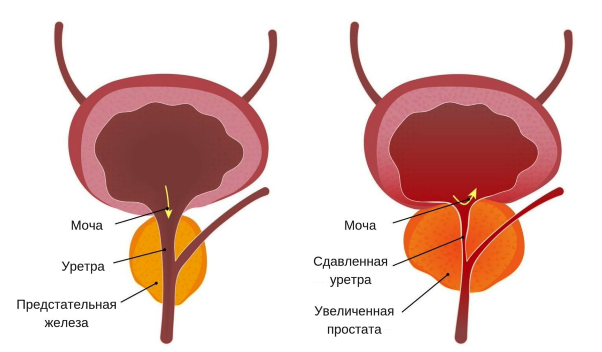 Простата развивается. Увеличенная предстательная железа. Простатит предстательной железы. Показывает рисунок простатит.