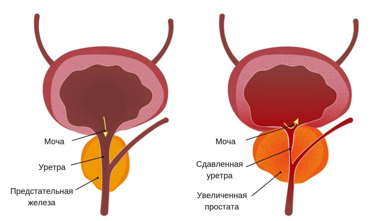 Предстательная железа лечение