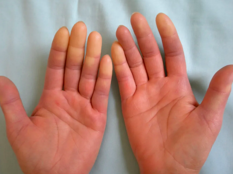 Белеют руки. Белеют руки. Безымянный палец. Акроцианоз синдром рейно. Акроцианоз синдром рейно.