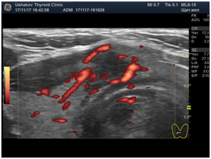 Ultrasound scan in EDC mode (vascular regimen). In the right side of the isthmus of the thyroid gland, the node with signs of cancer is: 1) an irregular shape, stretched not along, but across the isthmus, 2) contains significantly hypoechoic tissue, 3) the node border is discontinuous in some areas. Class TI-RADS corresponds to 4C. The blood flow of the node is of significant intensity with signs of disordered vascular distribution.