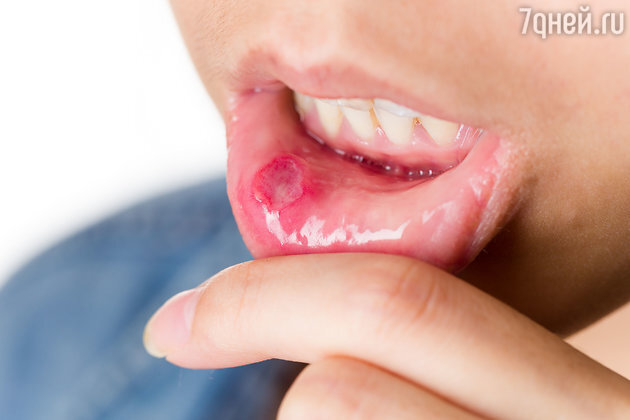 Лечение поражений слизистой оболочки полости рта, возникающих на фоне химиотерапии