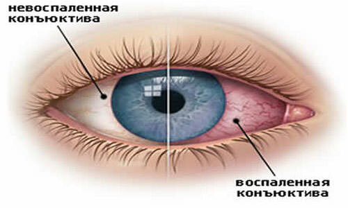 Схематичное изображение части интактной и воспаленной конъюнктивы глаза, проявляющейся выраженным покраснением за счет расширения поверхностных сосудов
